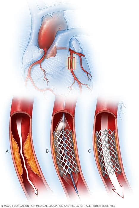 Angina Treatment Stents Drugs Lifestyle Changes — What