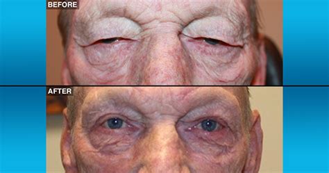 before and after northwest eyelid and orbital specialists ps and neos surgery center spokane