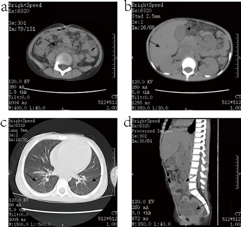The Chest Ct Manifestations Of Patient Show 1 Multiple Enlarged Lymph