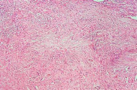 Histology And Immunohistochemical Stain For Igg4 Of The Gall Bladder