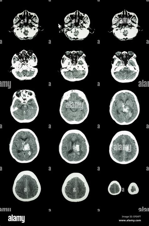Hemorrhagic Stroke Ct Scan Computed Tomography Of Brain
