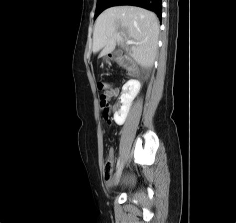 Malrotation Of Kidney Image