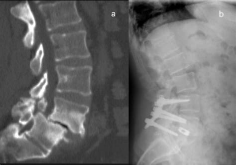 Posterior Lumbar Interbody Fusion With Instrumented Posterolateral