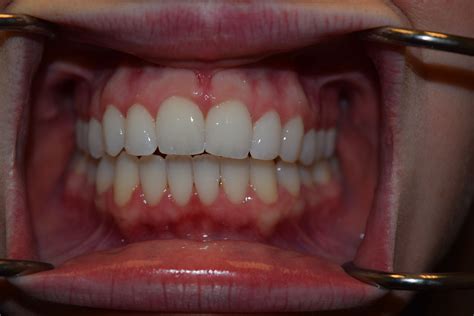 If you extract 4 teeth to fix an excess overjet then you have to close all the space. Invisalign - Austin, TX - South Lamar - Zilker - Bouldin