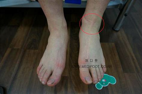 발목 수술로 인한 다리길이차이 2cm 난 매일 다른 사람의 발을 보고 산다.