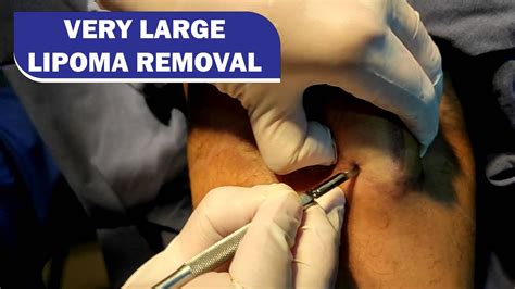 Scarless Lipoma Removal Surgery Done By Dr Prashant Yadav