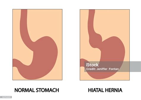 Hiatus Hernia Hiatal Hernia Types Of Hiatal Hernia Illustration Stock