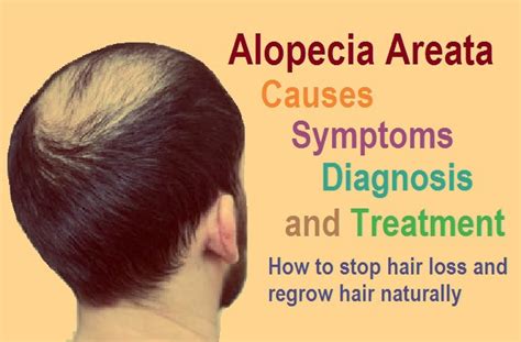Alopecia Areata Causes Symptoms And Treatment How To Stop Hair