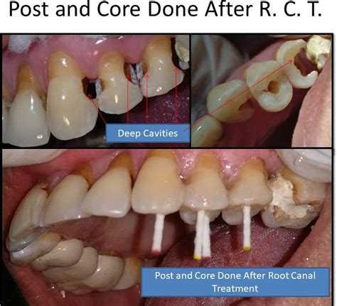 Post And Core After Root Canal Treatment Single Post Charges Mentioned