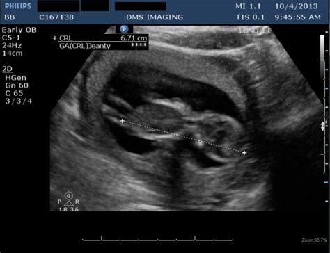 The most ideal time your dating scan is scan 8 to 12 weeks of pregnancy. What to expect at 8 week ultrasound