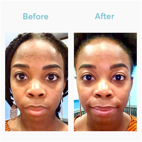 The Best Hyperpigmentation Treatment For Black Skin Mdacne