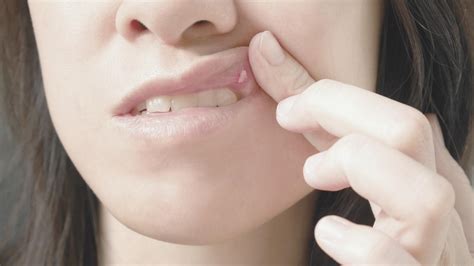 Todo lo que tienes que saber sobre las úlceras bucales Clínica Dental