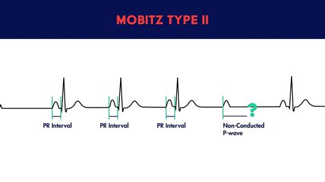 Second Degree Heart Block Mobitz Type Ii Youtube