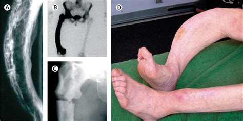 Pathogenesis And Management Of Paget S Disease Of Bone The Lancet