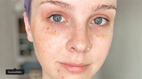 Spots 101 Your Ultimate Guide To Differentiating Pigmentation Spots