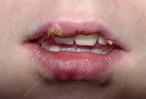 Cold Sores On The Lip Stock Image C0115520 Science Photo Library