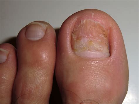 Ingrown Toenail Causes And Treatments Boulder County Foot And Ankle