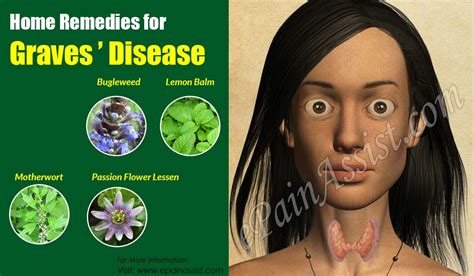 Home Remedies For Graves Disease