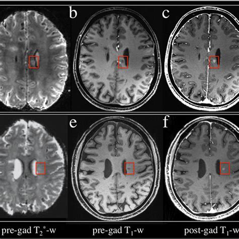 Brain Mri Showing Lesions