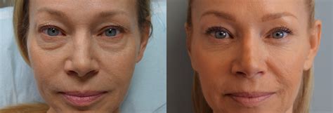 Lower Eyelid Blepharoplasty Before And After Photos Inland Empire