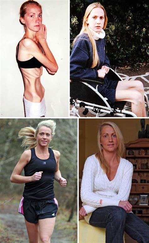 45 ‘before And After Photos Of People Who Beat Anorexia True Activist