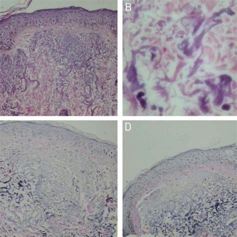 Serpiginous Raised Violaceous Skin Lesion In The Anterior Aspect Of The