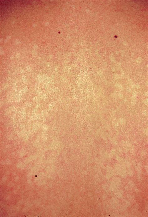 Pityriasis Pityriasis Versicolor Skin Infection Stock Image C002