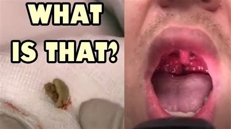 Throat Triple Feature Tonsil Stones Tonsillitis And Strep Youtube