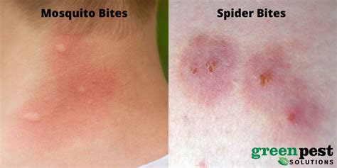 Mosquito Bites Vs Spider Bites How To Tell The Difference Green