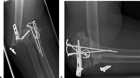Semiconstrained Total Elbow Arthroplasty For Posttraumatic Arthritis Or