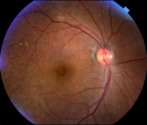 Application Of Optical Coherence Tomography And Macular Holes In