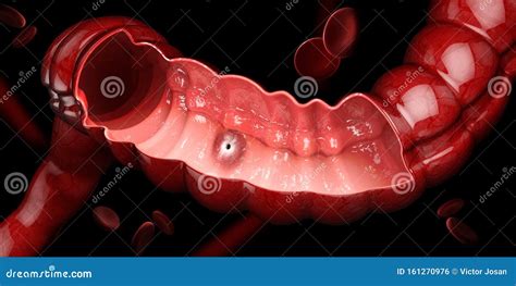 Peptic Ulcer 3d Illustration Of Human Stomach Anatomy Stock Photo