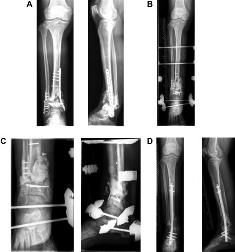 Treatment Of An Infectious Nonunion By Means Of The Masquelet