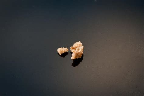 Pictures Of Different Types Of Kidney Stones