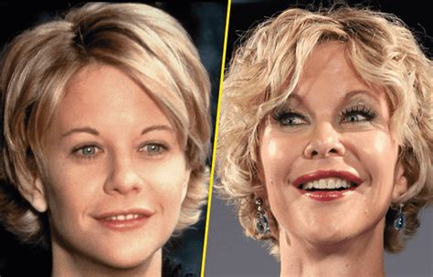 Meg Ryan Before And After Plastic Surgery Images