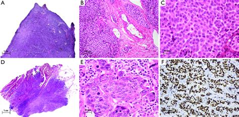 The Morphological Spectrum Of Large Cell Neuroendocrine Carcinoma