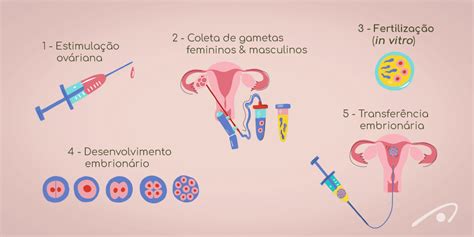 Estimulação Ovariana Saiba Mais Sobre A Técnica Art Medicina Reprodutiva