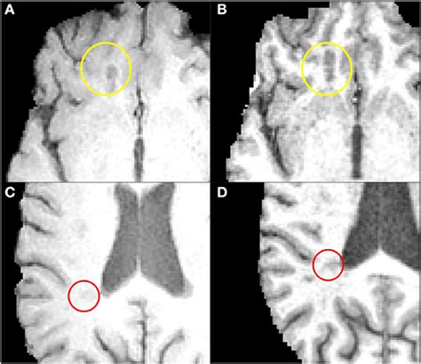 Frontiers Two Classes Of T1 Hypointense Lesions In Multiple Sclerosis