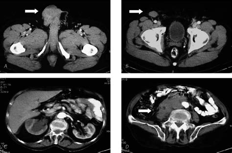Figure 2 From Clinical And Radiological Study Of Three Cases Of