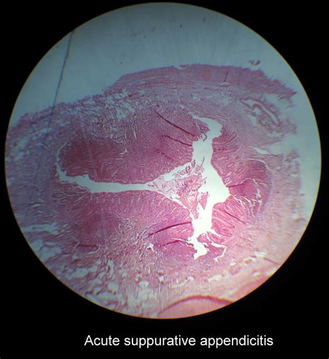 Acute Suppurative Appendicitis Albaraa Mehdar Flickr