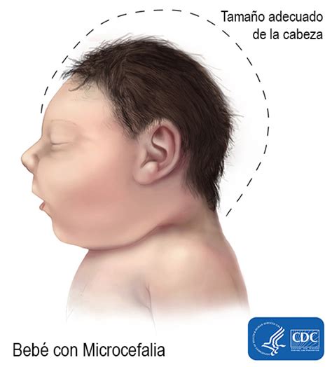 Defectos De Nacimiento Específicos Defectos De Nacimiento Ncbddd Cdc