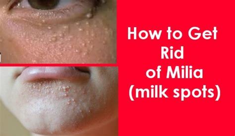 Milia Also Called Milk Spots Are Little White Or Yellowish Bumps That