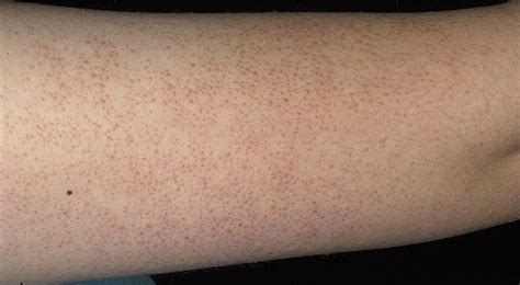 Confessions Of A Beauty Addict My Keratosis Pilaris Chicken Skin