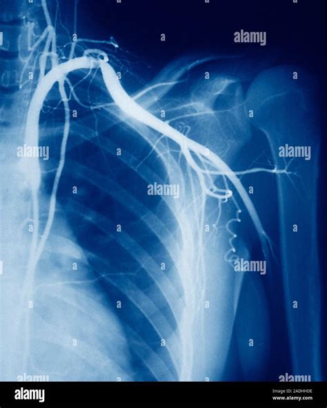 Arterial Narrowing Coloured Angiogram Blood Vessel X Ray Of The