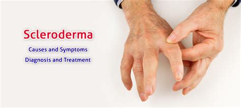 Scleroderma Causes Symptoms Diagnosis And Treatment Medplusmart