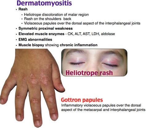 Dermatomyositis Fm Polymyositis Rash Rash Malar Rash Heliotrope Rash