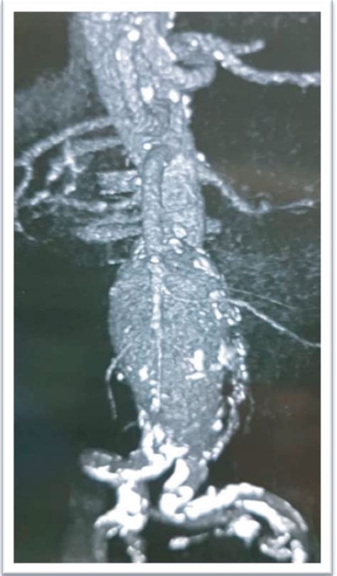 Abdominopelvic Ct Scan Without Contrast Before Aaa Repair Operation