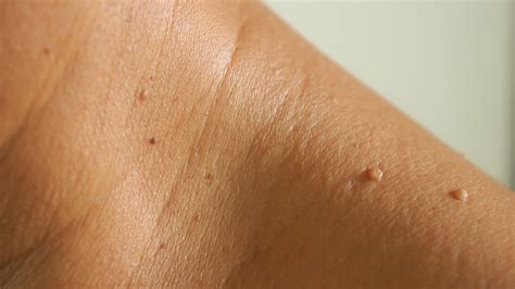 Mole Vs Freckle Understanding The Difference Between Moles And Freckles Spot Check Skin