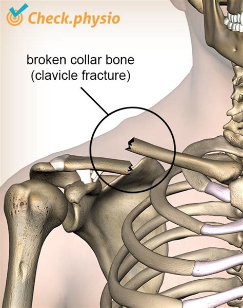 Broken Collarbone Physio Check