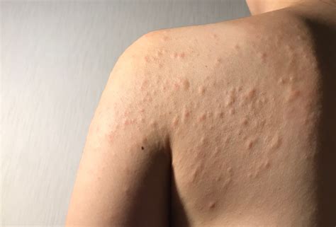 Hives Treatment And Allergy Testing Columbia Allergy Clinics